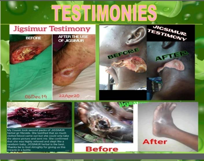 Jigs Healing Wound